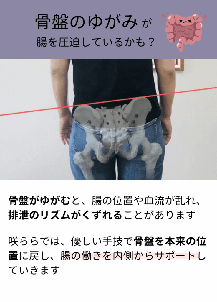 骨盤の歪みが腸を圧迫して便秘を引き起こす図解