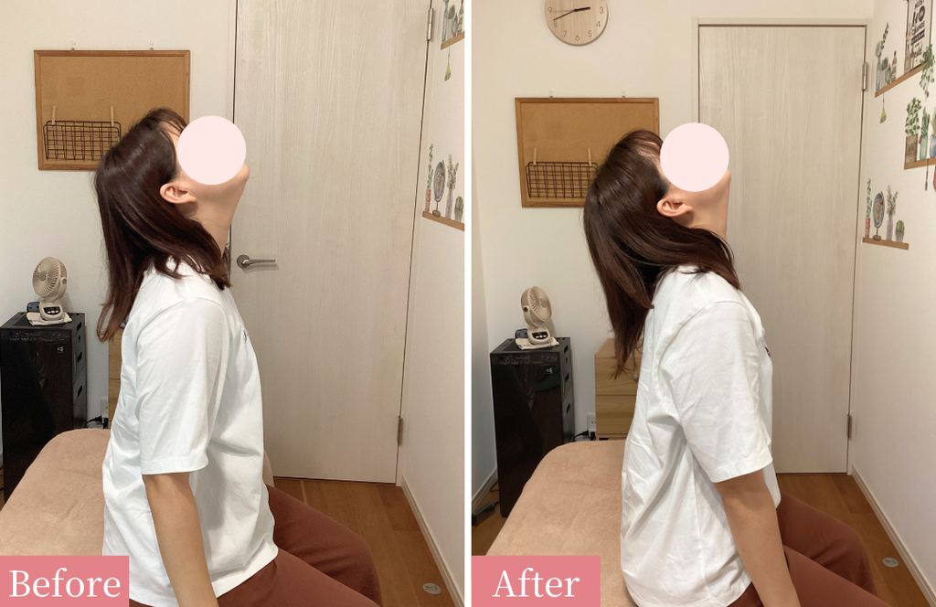 首の小屈ビフォーアフター